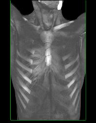 Pectus Deformity in 3D - CTisus CT Scan