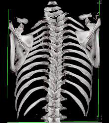 Pectus Deformity in 3D - CTisus CT Scan