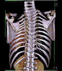 Pectus Deformity in 3D - CTisus CT Scan