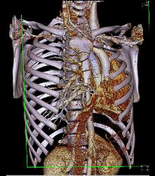 Pectus Deformity in 3D - CTisus CT Scan