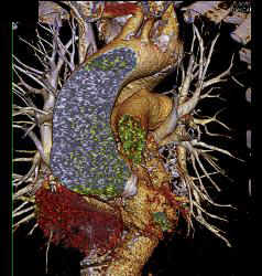 Aortic Valve Replacement With Dilated Ascending Aorta - CTisus CT Scan