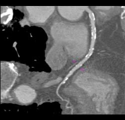 Coronary Artery Calcified Plaque Is Seen in Same Patient With Diseased Aortic Root With Aortic Valve Replacement (AVR) - CTisus CT Scan