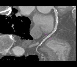 Coronary Artery Calcified Plaque Is Seen in Same Patient With Diseased Aortic Root With Aortic Valve Replacement (AVR) - CTisus CT Scan