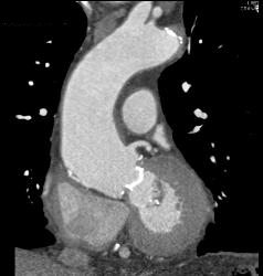 Aortic Valve Replacement With Dilated Ascending Aorta - CTisus CT Scan