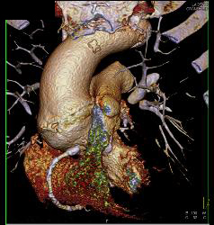 Aortic Valve Replacement With Dilated Ascending Aorta - CTisus CT Scan