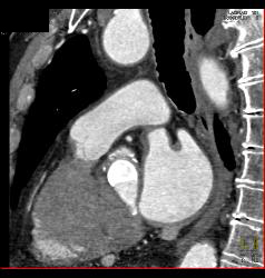 Aortic Valve Replacement With Dilated Ascending Aorta - CTisus CT Scan