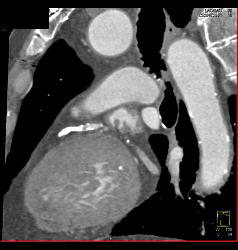 Aortic Valve Replacement With Dilated Ascending Aorta - CTisus CT Scan