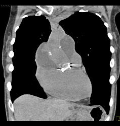 Fluid Around Root Repair - CTisus CT Scan