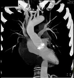 Fluid Around Root Repair - CTisus CT Scan