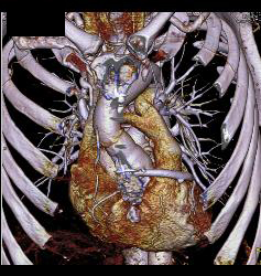 Fluid Around Root Repair - CTisus CT Scan