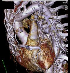 Fluid Around Root Repair - CTisus CT Scan