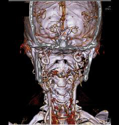 Ectatic Carotids in Loeys-Dietz Syndrome - CTisus CT Scan