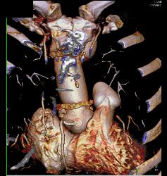 Aortic Root Repair - CTisus CT Scan