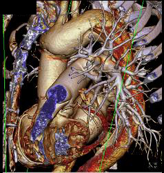 Aortic Root Repair - CTisus CT Scan