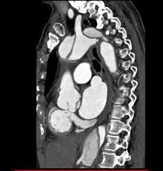 Type A Dissection - CTisus CT Scan