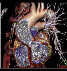 Dilated Ascending Aorta - CTisus CT Scan