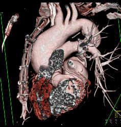 Dilated Ascending Aorta - CTisus CT Scan