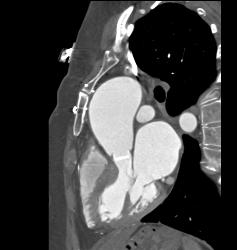 Aortic Valve Replacement (AVR) in Dilated Ascending Aorta - CTisus CT Scan