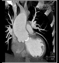 Aortic Valve Replacement (AVR) in Dilated Ascending Aorta - CTisus CT Scan