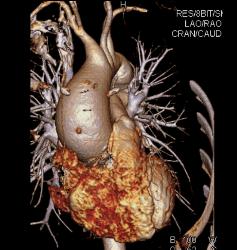 Aortic Valve Replacement (AVR) in Dilated Ascending Aorta - CTisus CT Scan