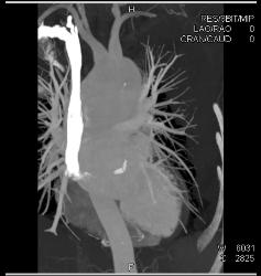 Aortic Valve Replacement (AVR) in Dilated Ascending Aorta - CTisus CT Scan