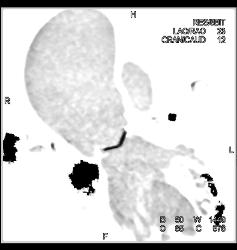 Aortic Valve Replacement (AVR) in Dilated Ascending Aorta - CTisus CT Scan