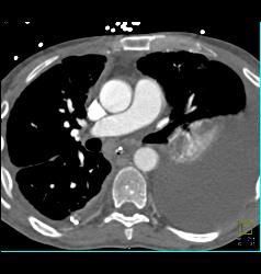 Subtle Left Pulmonary Embolism (PE) With Collapsed Left Lower Lobe and Pleural Effusion - CTisus CT Scan