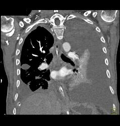 Subtle Left Pulmonary Embolism (PE) With Collapsed Left Lower Lobe and Pleural Effusion - CTisus CT Scan