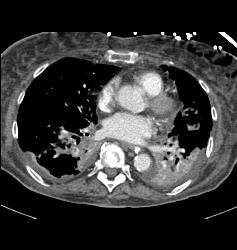 Multiple Pulmonary Emboli (PEs) - CTisus CT Scan