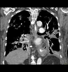 Multiple Pulmonary Emboli (PEs) - CTisus CT Scan