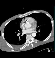 GSW With Bullet in Heart - CTisus CT Scan