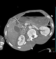 GSW With Bullet in Heart - CTisus CT Scan