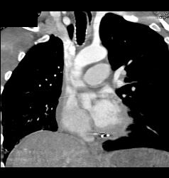 GSW With Bullets Near Heart - CTisus CT Scan