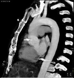 GSW With Bullets Near Heart - CTisus CT Scan