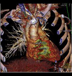 GSW With Bullets Near Heart - CTisus CT Scan