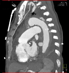 Leak From Descending Aorta - CTisus CT Scan