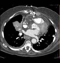 Pulmonary Embolism (PE) in Right Pulmonary Artery and Left as Well- See Full Sequence - CTisus CT Scan