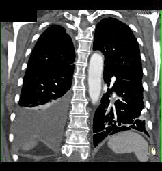 Pulmonary Embolism (PE) in Right Pulmonary Artery and Left as Well- See Full Sequence - CTisus CT Scan