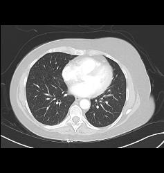 Pulmonary Embolism (PE) in Right Pulmonary Artery and Left as Well- See Full Sequence - CTisus CT Scan