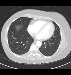 Pulmonary Embolism (PE) in Right Pulmonary Artery and Left as Well- See Full Sequence - CTisus CT Scan