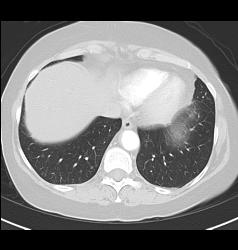 Pulmonary Embolism (PE) in Right Pulmonary Artery and Left as Well- See Full Sequence - CTisus CT Scan