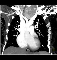 Substernal Thyroid - CTisus CT Scan