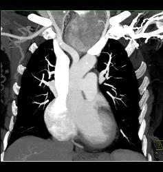 Substernal Thyroid - CTisus CT Scan