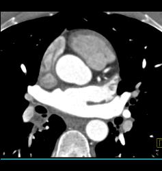 Pseudothrombus in Left Atrial Appendage - CTisus CT Scan