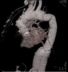 Aortic Root and Arch and Descending Aorta Repair - CTisus CT Scan