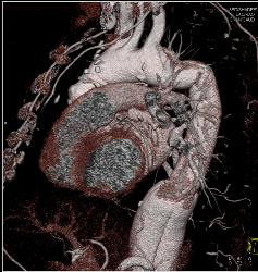 Aortic Root and Arch and Descending Aorta Repair - CTisus CT Scan