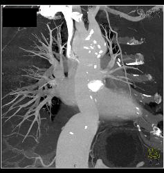 Aortic Root and Arch and Descending Aorta Repair - CTisus CT Scan