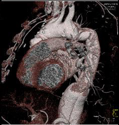 Aortic Root and Arch and Descending Aorta Repair - CTisus CT Scan