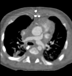 Patent B-t, Blalock Taussig, Shunt- See Full Sequence - CTisus CT Scan