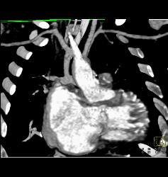 Patent B-t, Blalock Taussig, Shunt- See Full Sequence - CTisus CT Scan